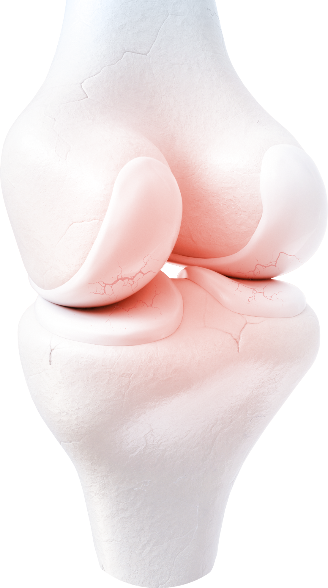 osteoarthritis